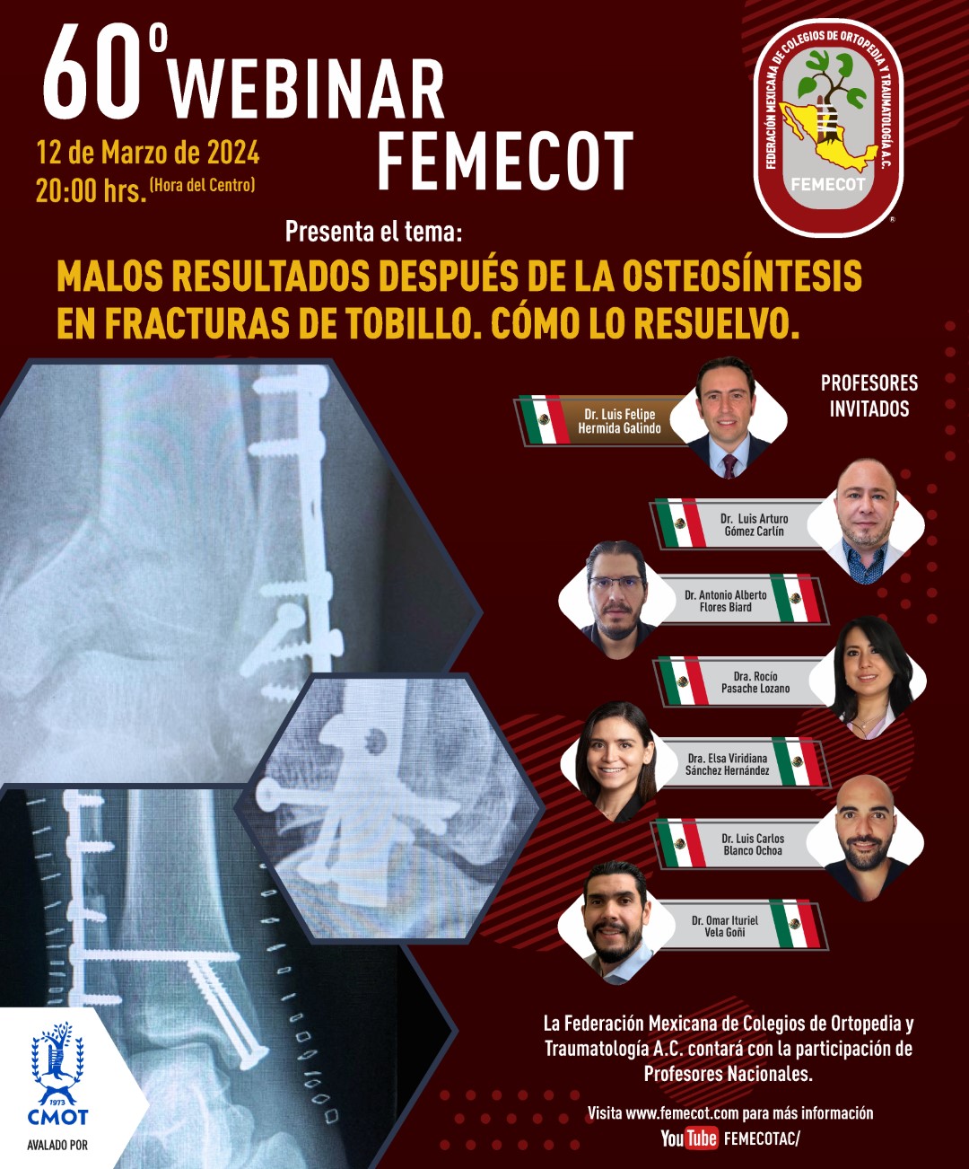 60o Webinar FEMECOT: Malos resultados después de la osteosíntesis en fracturas de tobillo. ¿Cómo lo resuelvo?